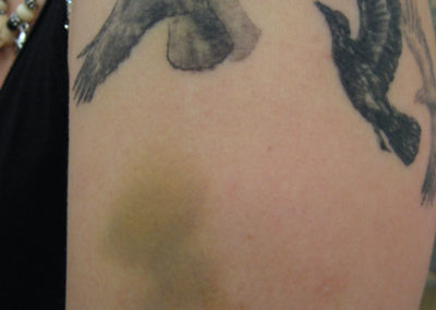 An artistic photograph of a bruised arm, a pigment spot, and flying crows.