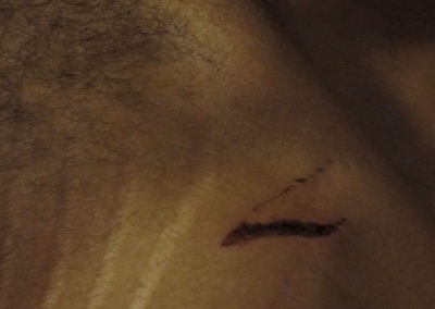 Art photography of a black male's chest and collarbone, with stretch marks and a wound