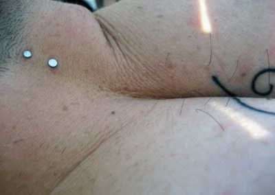 Digital photograph of a man's neck, with dermal anchors.