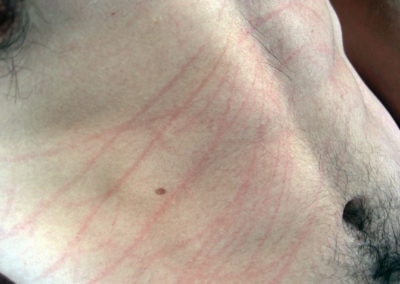 Digital art photography of a white male torso with red scratch-marks.